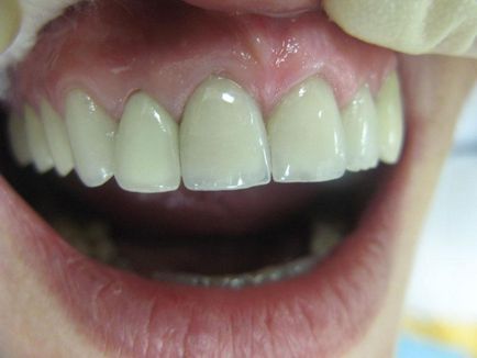 Види зубних коронок - характеристики зубних коронок