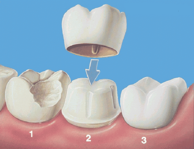 Tipuri de coroane dentare - caracteristicile coroanelor dentare