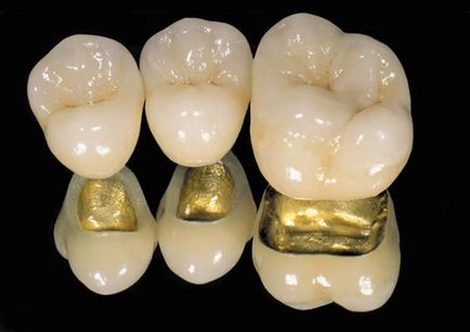 Tipuri de coroane dentare - caracteristicile coroanelor dentare
