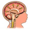 Водянка головного мозку лікування, симптоми і причини