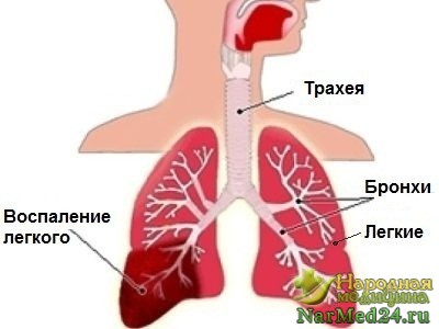 Vospaslenie okoz tüdőszövődményeket, hatékony kezeléshez és népi jogorvoslati