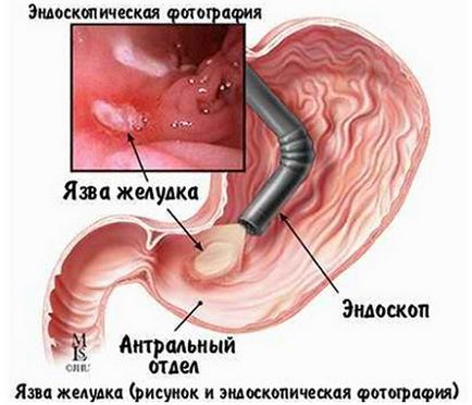Ulcerul stomacului prepyloric - principalele cauze și modalități de tratament