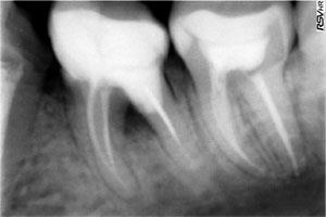Închiderea perforației operative în zona dinților 3
