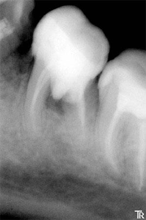 Închiderea perforației operative în zona dinților 3