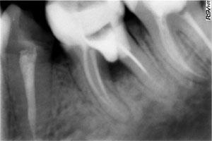 Закриття оперативної перфорації в області зуба 3