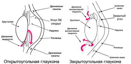 Закритокутова глаукома причини, симптоми, особливості лікування