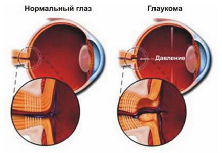 Glaucomul cu unghi închis cauzează simptome, trăsături de tratament