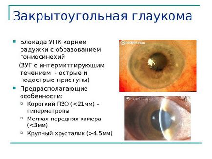 Glaucomul cu unghi închis cauzează simptome, trăsături de tratament