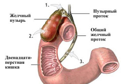 Запори після видалення жовчного міхура