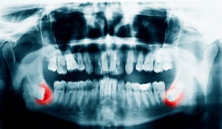 Зуб мудрості симптоми, ускладнення, лікування або видалення