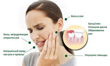 Simptomele înțelepciunii dintelui, complicațiile, tratamentul sau îndepărtarea