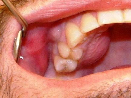 Simptomele înțelepciunii dintelui, complicațiile, tratamentul sau îndepărtarea