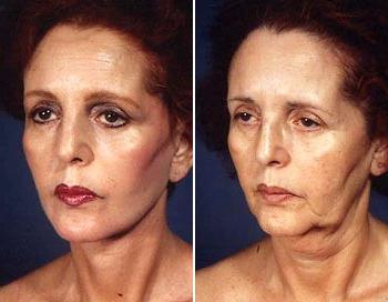 Non-chirurgical lifting facial (non-chirurgical de ridicare a feței) Non-chirurgical de ridicare a feței