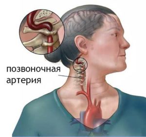 Fájdalom osteochondrosis a nyaki gerinc eltávolítása, fájdalomcsillapítók