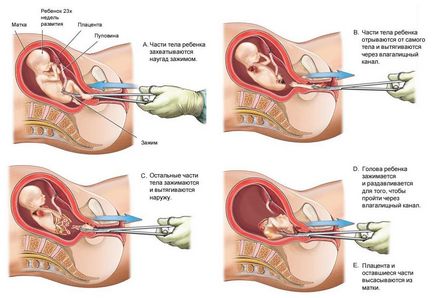 Fáj a teendő, ha a vákuum abortusz, sebészeti és egyéb