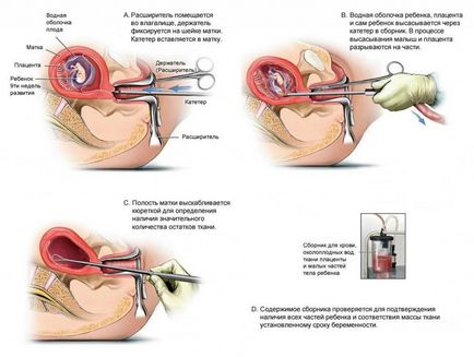 Este dureros să faci vaccin de avort, chirurgical și altele