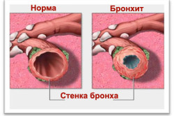 Bronchitis etiológiája és patogenezise