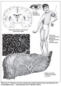 Ce este degenerarea hepatolenticulară și simptomele acesteia?