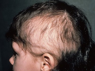 Specii de alopecie pediatrică, cauze ale bolii și tratament