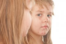Diatatea sau dermatita atopică în regulile copiilor privind comportamentul părinților, până la trei ani