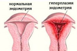 Гіперплазія ендометрію симптоми і лікування народними засобами в домашніх умовах