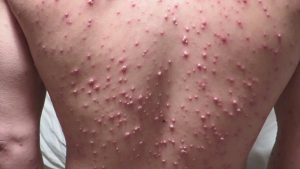 Simptome purulente cu varicela, cum ar fi tratamentul adulților și copiilor