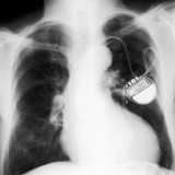 Implantarea, instalarea și costul stimulatorului cardiac g