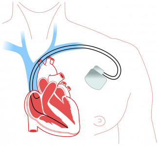 Implantarea, instalarea și costul stimulatorului cardiac g