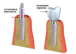 імпланти kos