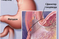 Печія і її симптоми