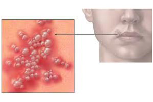 Cum de a vindeca rapid herpesul pe buze