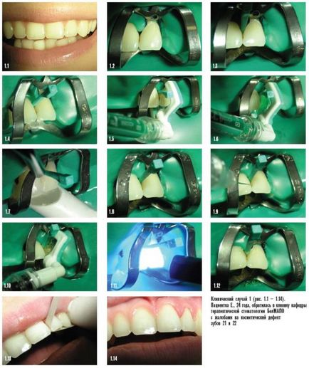 Cum sa curatati dintii de carii dentare!