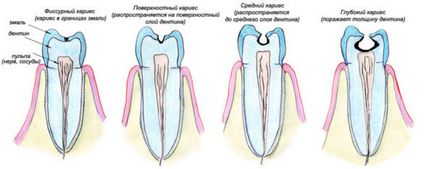 Cum sa curatati dintii de carii dentare!