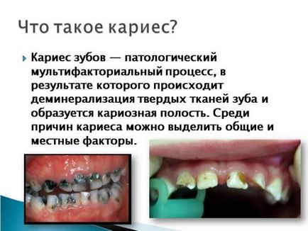 Як очистити зуби від карієсу докладна інформація!
