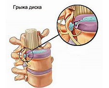 Cum am scăpat de ciupirea nervului spinal timp de 3 zile fără medicamente și un manual