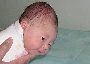 Kefalogematoma la nou-născuți, cauzele apariției lor, diagnosticul, complicațiile, tratamentul și prevenirea acestora