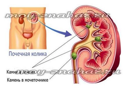 Журавлина при каменях у нирках, користь і шкода