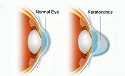 Corelarea unei noi metode de tratament a centrului keratoconus-oftalmologic din Konovalov, Kazahstan,