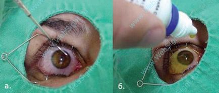 Corelarea unei noi metode de tratament a centrului keratoconus-oftalmologic din Konovalov, Kazahstan,