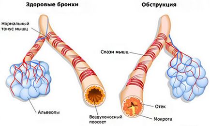 Гавкаючий кашель у дитини як лікувати правильно і безпечно