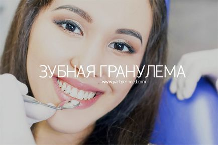 Лікування гранульоми на корені зуба, причини, симптоми, видалення гранульоми вартість, тюмень
