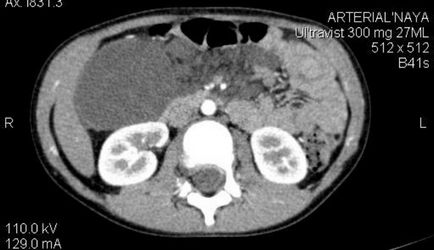 Limfangiomul cavității abdominale