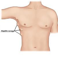 Lipome în tot corpul, ce trebuie să faceți pentru a trata lipomii