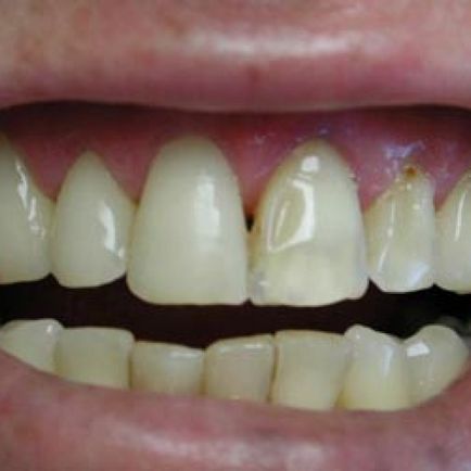Міжзубний карієс лікування і профілактика, причини і симптоми карієсу між передніми зубами, ціни в