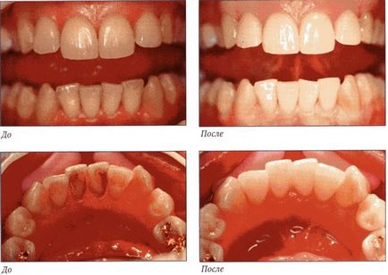 Interdentális szuvasodás megelőzésére és kezelésére okait és tüneteit hanyatlás az elülső fogak, aránya