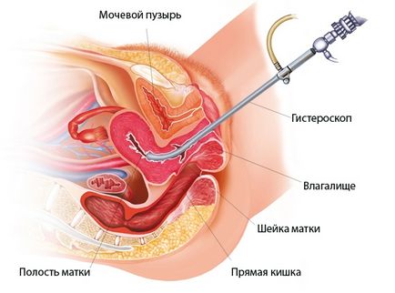 Рясні місячні після гістероскопії з вискоблюванням можуть початися, які бувають -