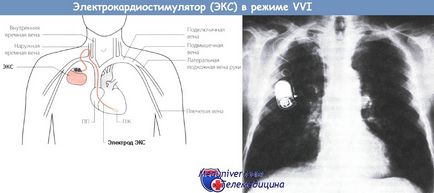 Ускладнення установки (імплантації) кардіостимулятора