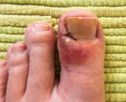 Panaritiumul de pe degetul mare suferă de astfel de inflamații cel mai adesea
