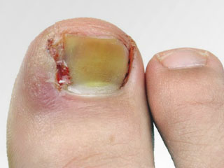 Панариций на пальці ноги лікування хірургічне, антибіотиками та маззю від нариву на великому пальці