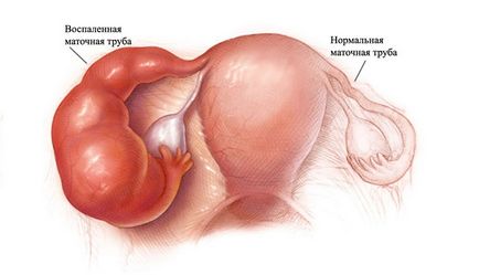 Патології та захворювання маткових труб (непрохідність труб, сальпінгіт, гідросальпінкс, спайки,